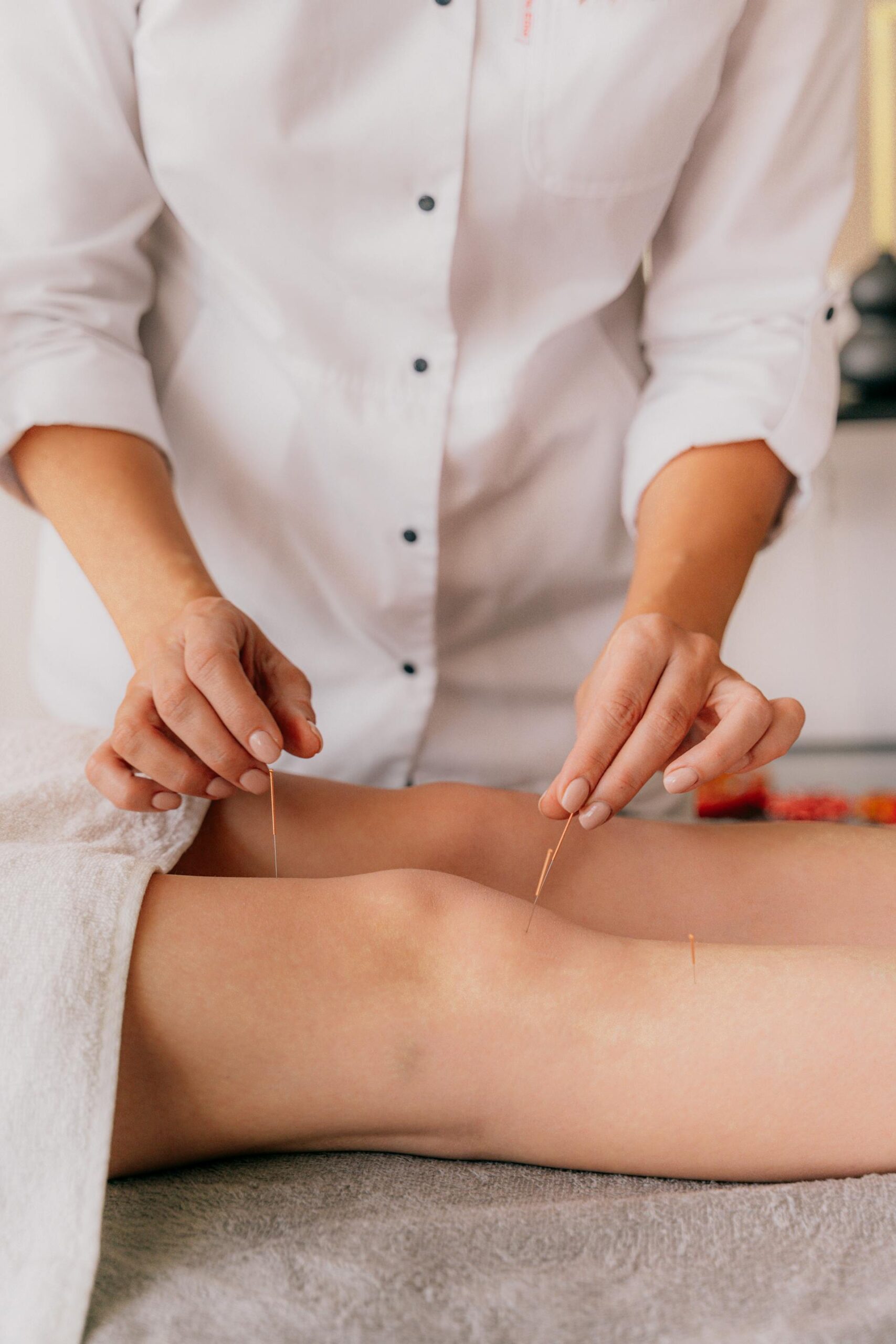 Acupuncturist Gold Coast, Acupuncture near me